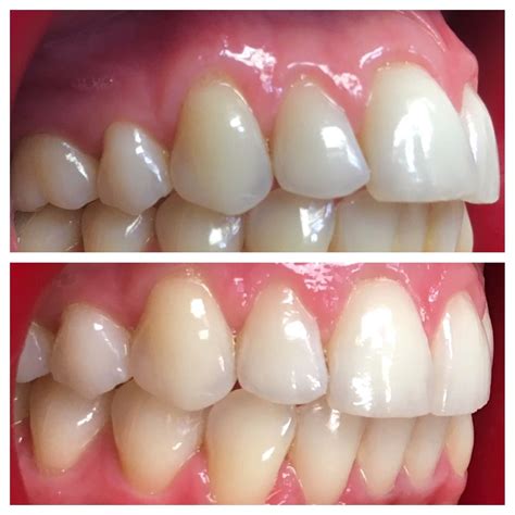 Smile Direct Whitening Before And After Before And After