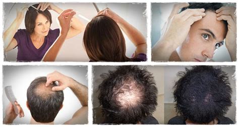 how to regrow thinning hair how “total hair regrowth” helps people