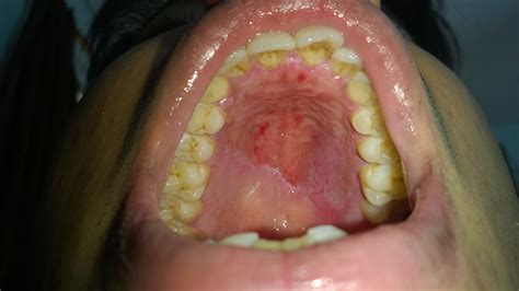 pain  swelling   roof   mouth   roof