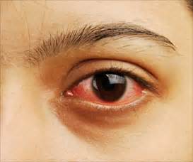 eye discharge symptom evaluation