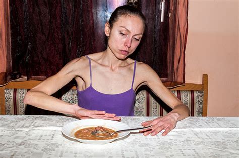 Anoreksiya Nervoza Ve Kısırlık Nova Fertil