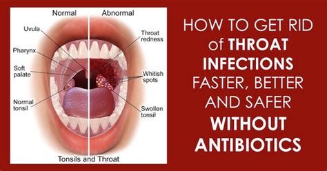 strep throat is caused by the streptococcus pyogens bacteria which