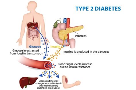 nonpharmacologic therapies  type  diabetes mellitus
