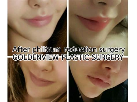 Goldenview Plastic Surgery Lips Plastic Surgery Before