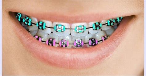 teal and purple colors for your braces or brackets cute braces cute