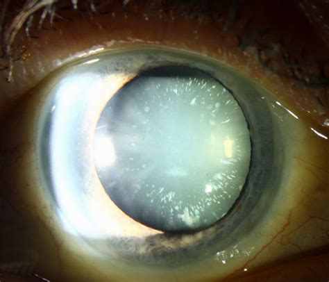 atlas entry cerulean cataract