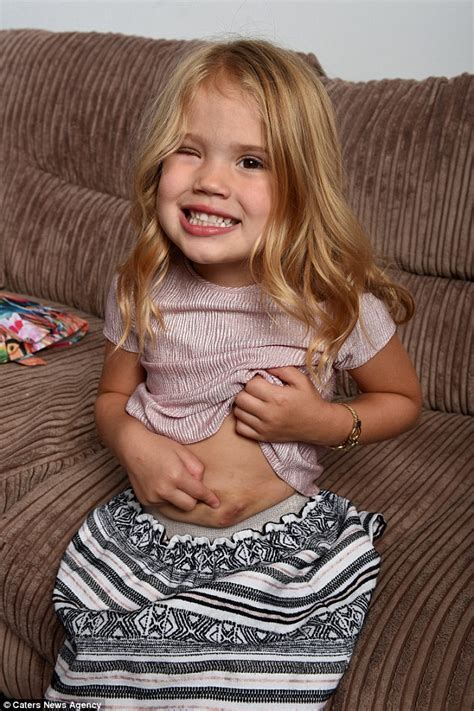 uk girl born without an eye has one created from her own stomach fat
