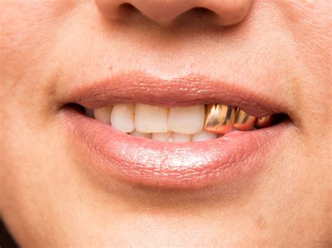 permanent gold teeth history cost pros cons