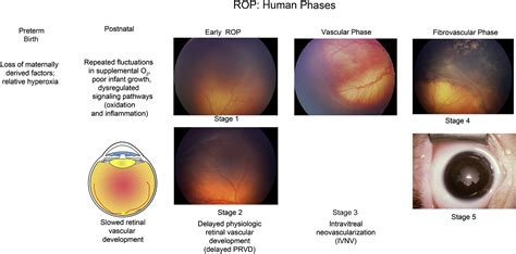 pathophysiology  mechanisms  severe retinopathy  prematurity