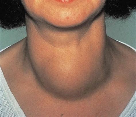 thyroid goiter  symptoms treatment diagnosis  prevention galleria community