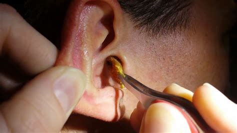 top  disgusting ear wax removals youtube