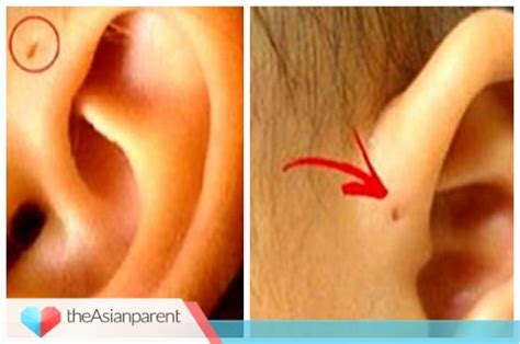 preauricular ear pit baby  parents  worried   hole