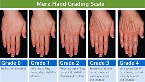 Hand Rejuvenation Pinnacle Dermatology