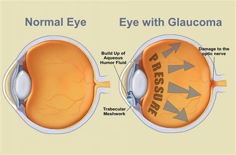 eye disease glaucoma symptoms management treatment  prevention