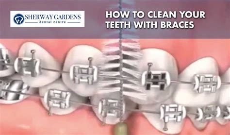 clean  teeth  braces
