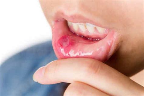 top 4 homeopathic medicines for mouth ulcers homeopathica