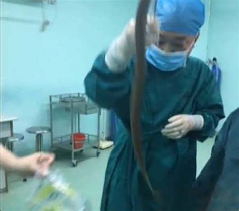 بالفيديو والصور لحظة قيام أطباء بإخراج ثعبان بحر من جسد رجل