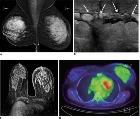 inflammatory breast cancer in 52 year old woman a mamm open i