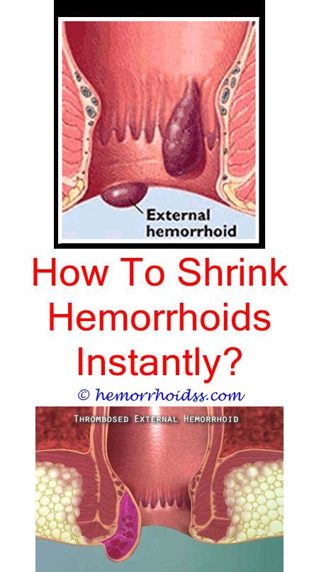 wonderful unique ideas can your period cause hemorrhoids what are the treatment for