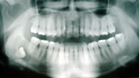 laserdennist wisdom   wisdom teeth