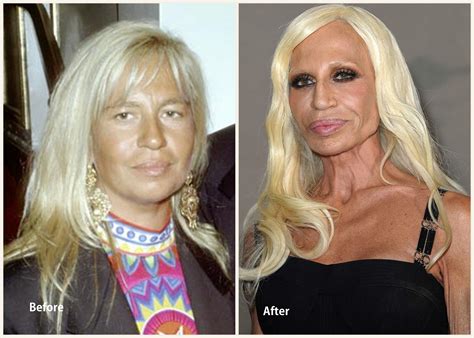 Donatella Versace Plastic Surgery Before And After Photo Showing Lip