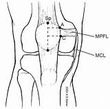 Mpfl Patellofemoral Ligament Medial Tear Reconstruction Joint Orthobullets Patella Dislocation Subluxation Restraints Flexion sketch template