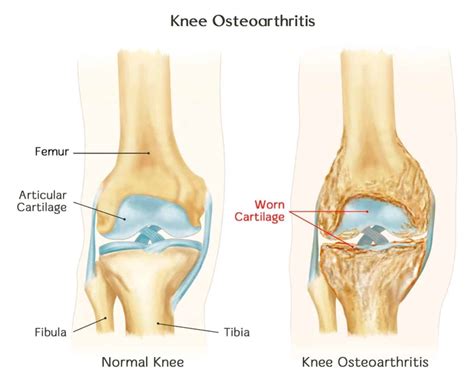 knee osteoarthritis mississauga  oakville chiropractor  physiotherapy clinic  consult
