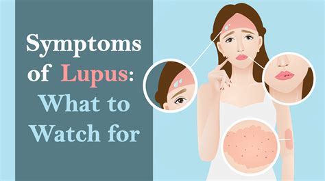 silent symptoms  lupus    womenworking