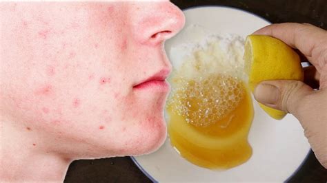 how to get rid of acne stains and pimple marks naturally youtube