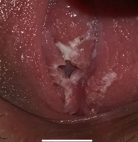 Is This Hpv Yeast Infection Herpes I’m Desperate