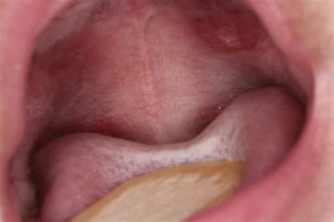 Aphthous Stomatitis Major In A 4 Month Old Infant Journal Of