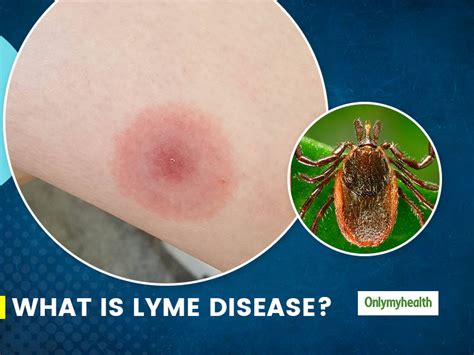 What Is Lyme Disease Here Are Its Causes Symptoms Prevention And