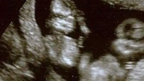twin ultrasound 12 weeks dating and chorionicity scan about twins