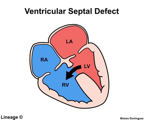 ventricular septal defect vsd cardiovascular medbullets step