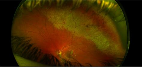 Commotio Retinae With Vitreous Hemorrhage Sonoran Desert Eye Center