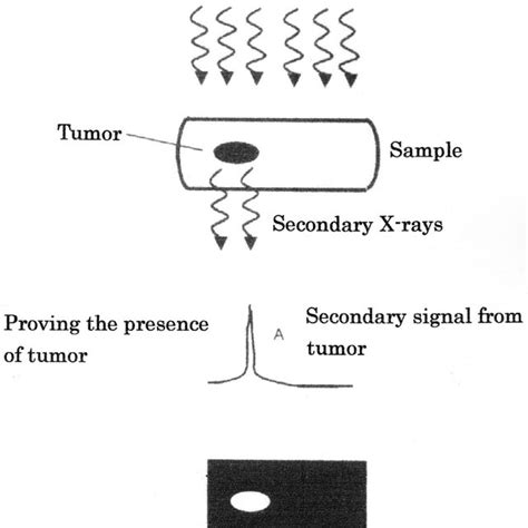 A Mammogram Of Female Breast Revealing Micro Calcifications White