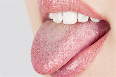 7 Effective Home Remedies For Furry Tongue Home Remedies