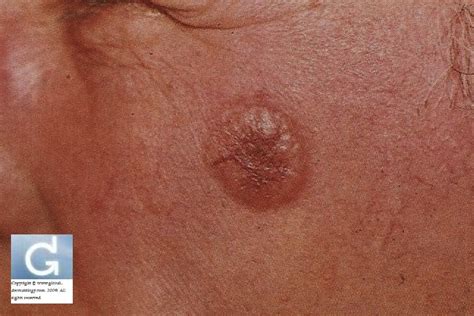carcinomas de celulas basales carcinoma basocelular fotos global dermatology