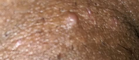 Is This Genital Warts Hpv Help Sexual Health