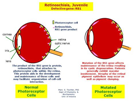 retinoschisis juvenile hereditary ocular diseases