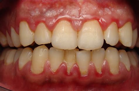 gum disease sounds terrible    dental  keys