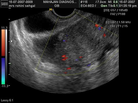 drarun mahajan ruptured ectopic