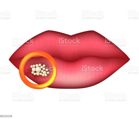 herpes on the lip infographics vector illustration on isolated