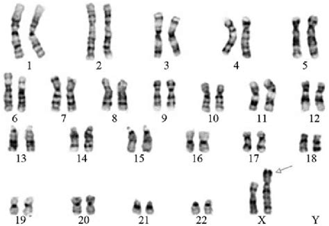 fetal g banding karyotype 46 x der x inv x p22 3q28 t