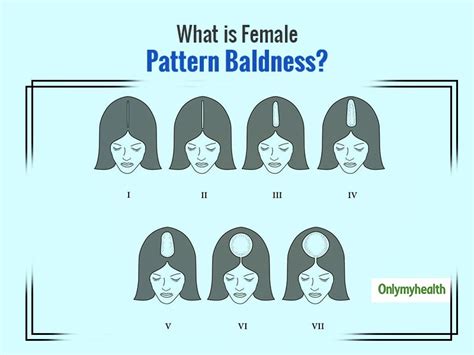 female pattern hair loss symptoms stages  treatment onlymyhealth