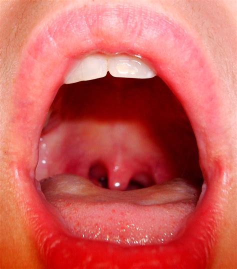 tonsils           throat  flickr