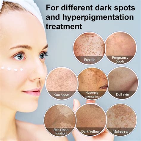 dark spot remover  face hyperpigmentation treatment melasma