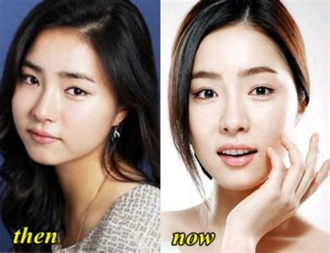 Zhang Yu Xi Plastic Surgery Before And After