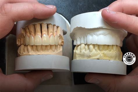 diagnostic wax  model  dental restoration replica iverson