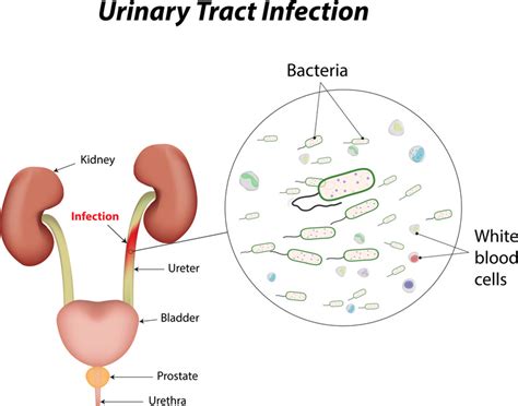 Acupuncture Treatment For Recurrent Urinary Tract Infection
